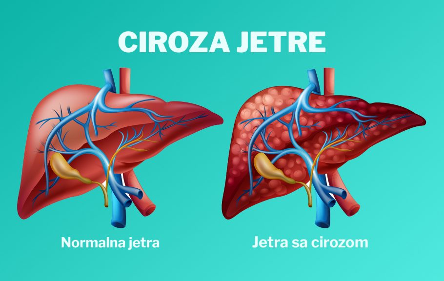 Ciroza jetre - PLIVAzdravlje