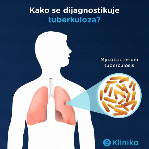 Plućna tuberkuloza