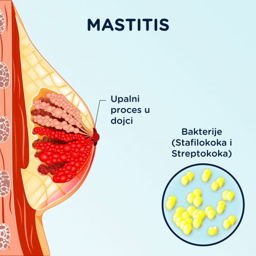 Mastitis je infekcija mlečnih kanala u dojci