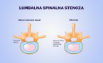 Lumbalna spinalna stenoza